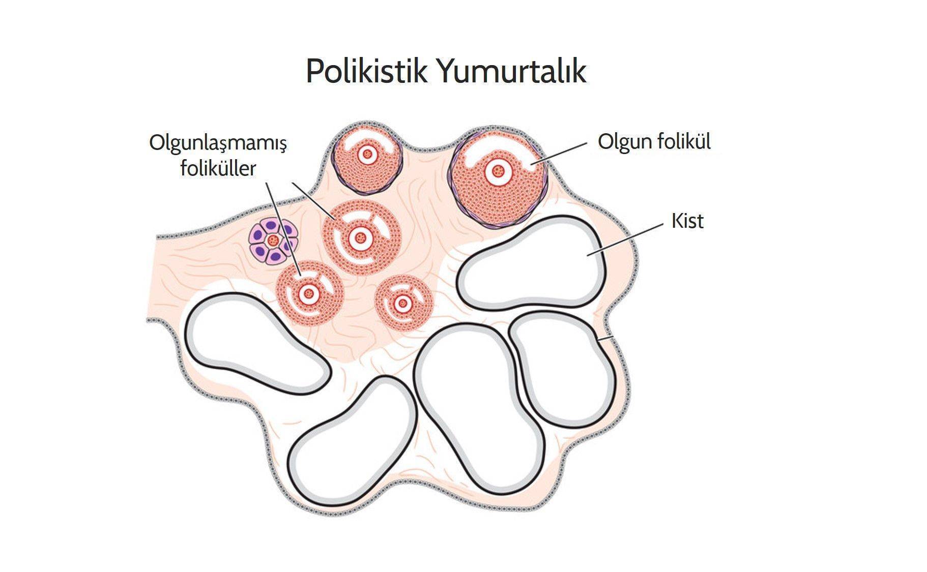 Polikistik Over Sendromu Nedir?