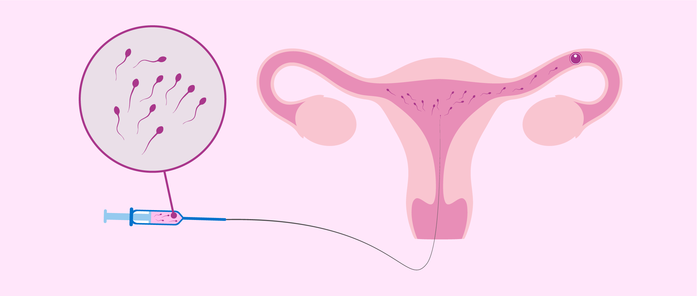 Aşılama (İntrauterin İnseminasyon - IUI)