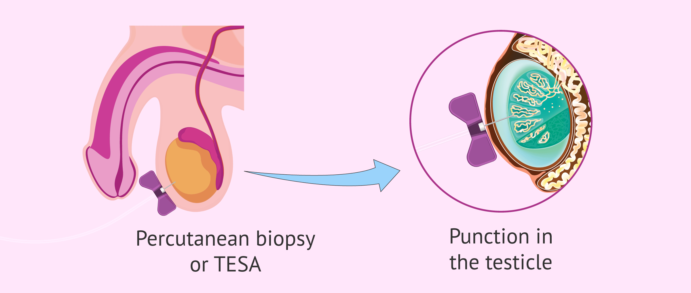 TESA (Testiküler Sperm Aspirasyonu)