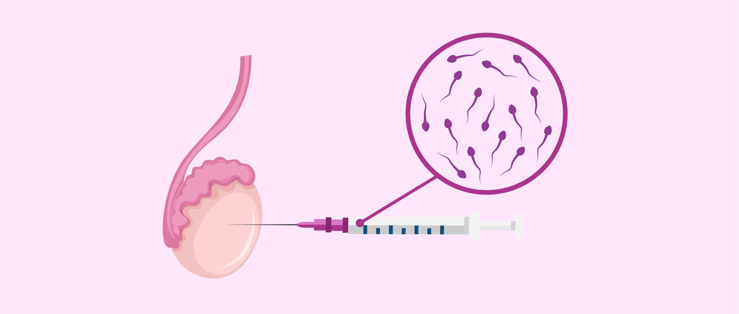 TESE (Testiküler Sperm Ekstraksiyonu)